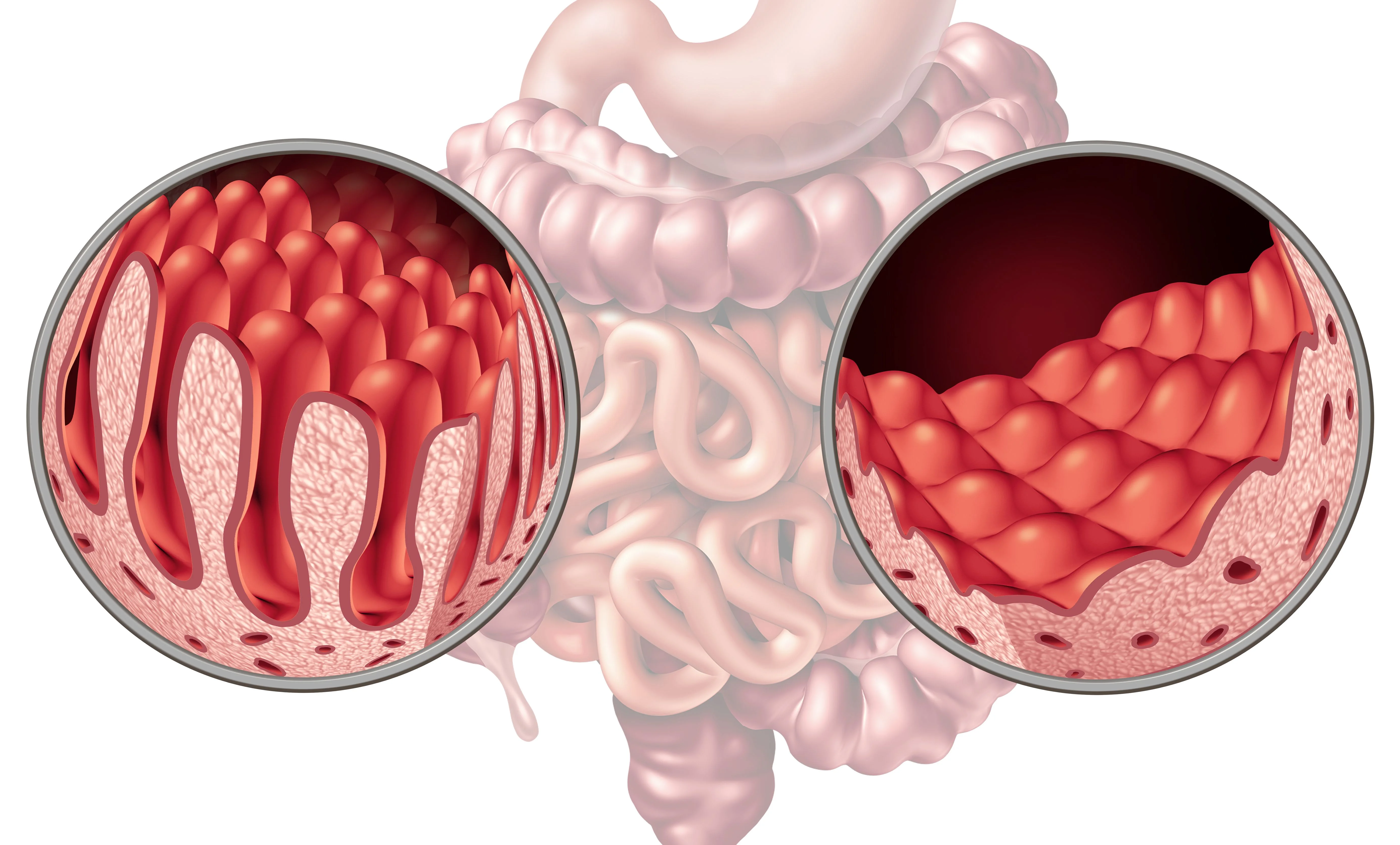 Cross-sectional view of intestines highlighting healthy and damaged tissue textures in magnified circular insets